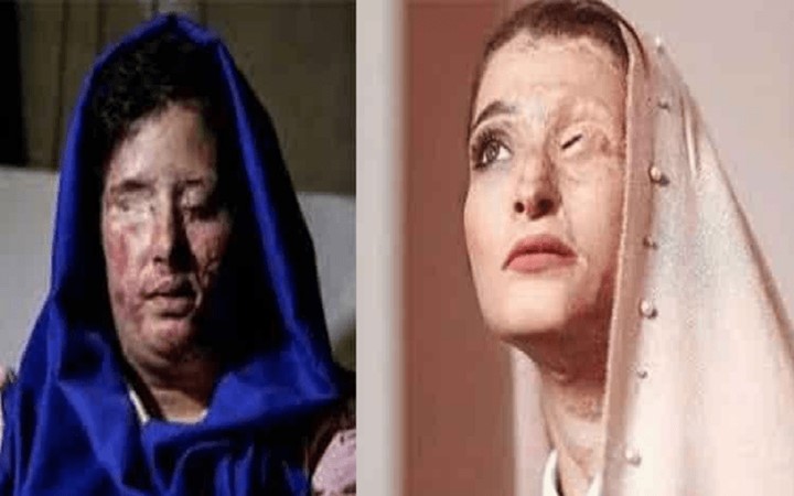 Sensitive Image - Iranian women who fell victim to government-backed acid attacks slam the supreme leader Ali Khamenei representatives due to their hate-mongering remarks
