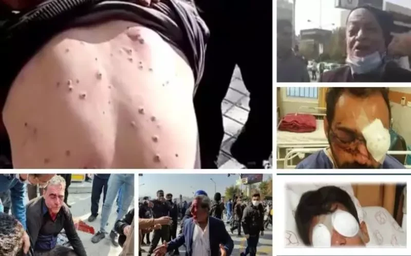 During the recent protests in Isfahan, Iran regime's forces injured many of the farmers and people who joined their peaceful protests with the shot pellet guns. Many of them lost at least one of their eyes.